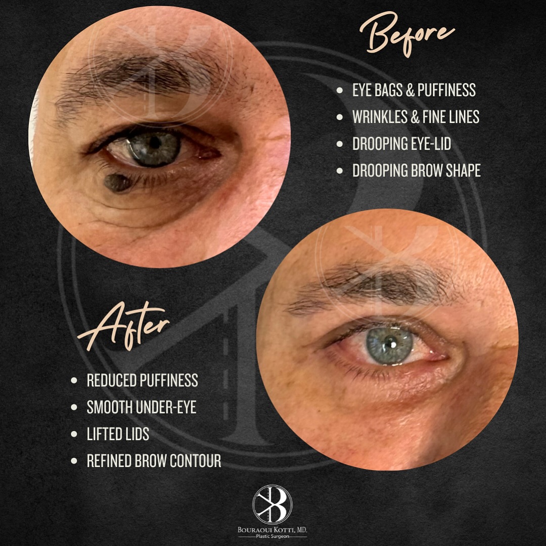 Eye refinement Dubai — before surgery clinical assessment by specialist plastic surgeon Dr. Kotti | EBOPRAS Certified Surgeon (16)